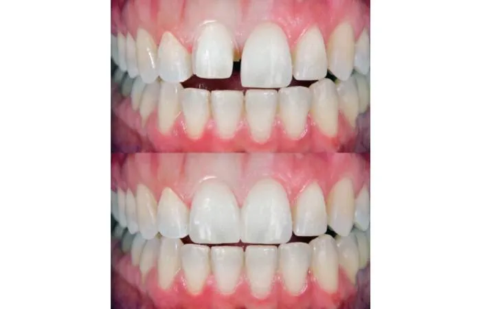 ציפוי שיניים עשוי מזירקוניה