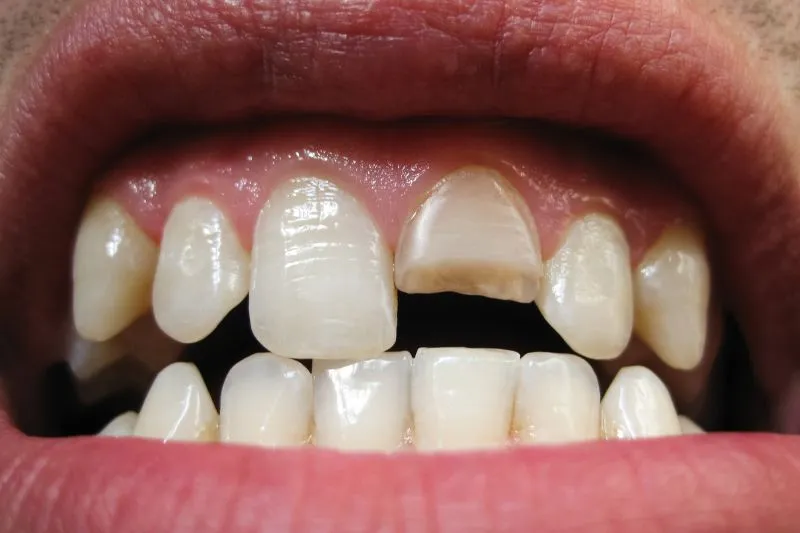 השלמת שן קדמית | שיניים קדמיות שלמות