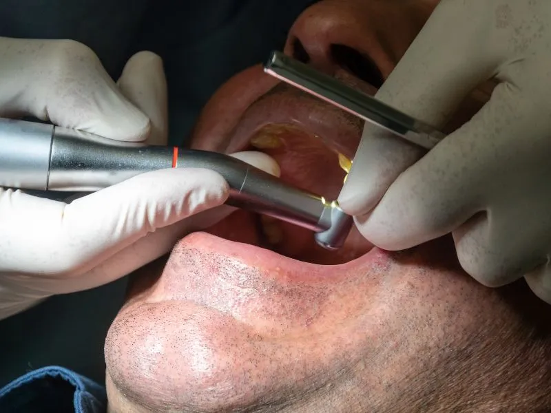 השתלת שיניים ללא כאבים - פתרון נוח לאובדן שיניים
